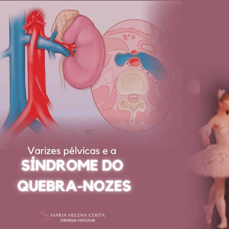 varizes pelvicas e a sindrome do quebra nozes