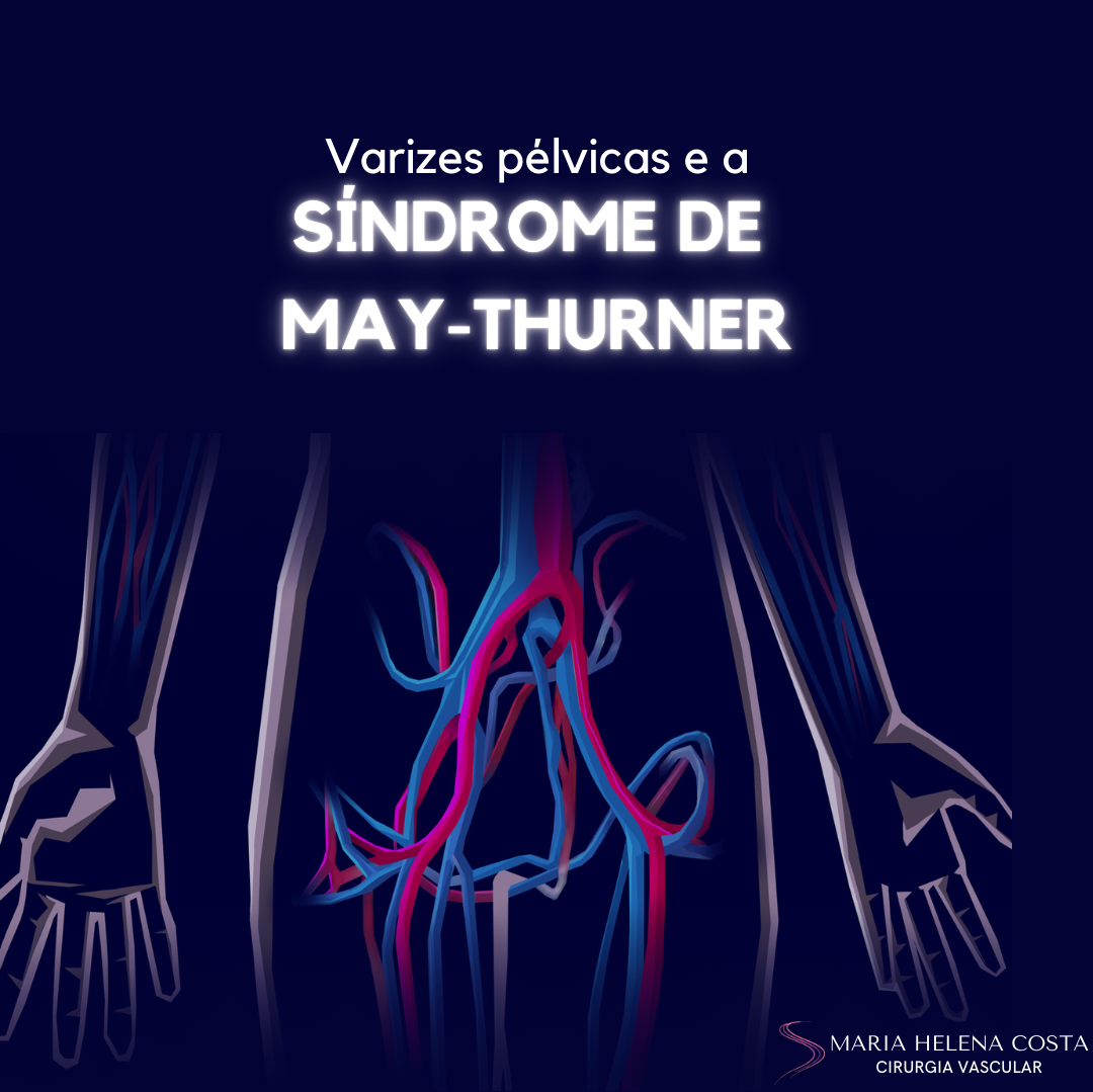 varizes pelvicas sindrome de may thurner