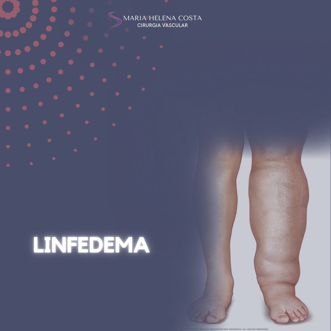 Linfedema