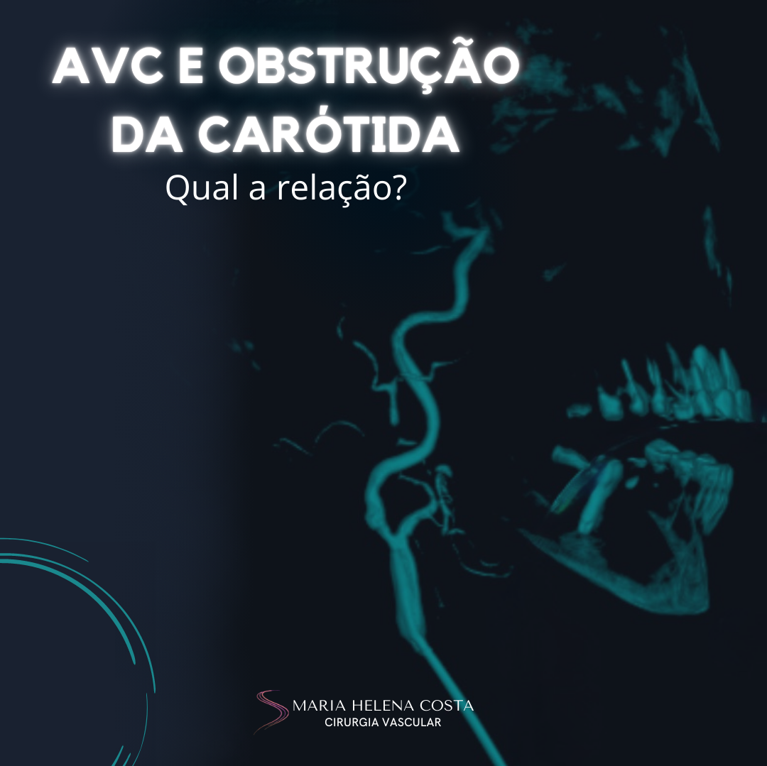 AVC e doença da carótida