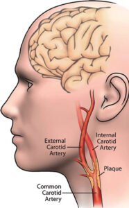 carotida avc