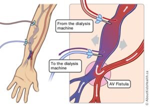 fistula hemodialise