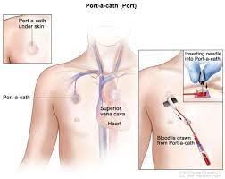 port o cath cateter